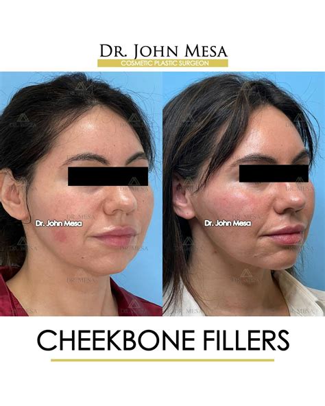 Cheekbone Filler Before & After Photos | Dr. Mesa