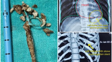 In Hyderabad, doctors remove discarded stent, stones from man’s kidney ...