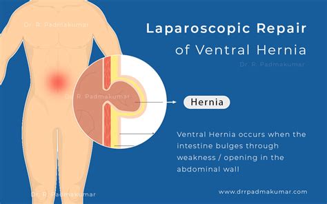 Ventral Hernia, - Repair and Treatment - Dr. R. Padmakumar