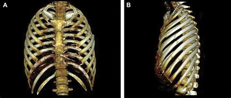 Addition of Video-Assisted Thoracoscopic Surgery to the Treatment of Flail Chest - The Annals of ...