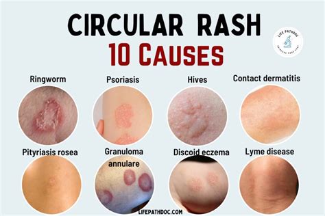 10 Causes of a Circular Rash, with Pictures