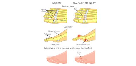 Plantar Plate Tear/Rupture: Causes, Symptoms & Treatment - Dr Foot Podiatry