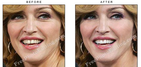 Free photo editing: Madonna's front teeth gap closed with digital cosmetic dentistry (Sample 1)