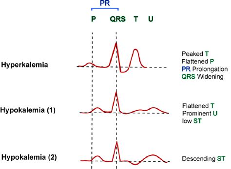 Ecg Changes In Hyperkalemia And Hypokalemia Causes Diagnosis | The Best ...