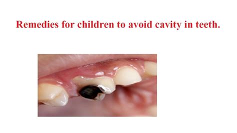 Remedies for children to avoid cavity in teeth - YouTube