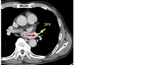 Unexpected Intraoperative Resecting of Common Trunk of Pulmonary Vein Resulted in an Incidental ...