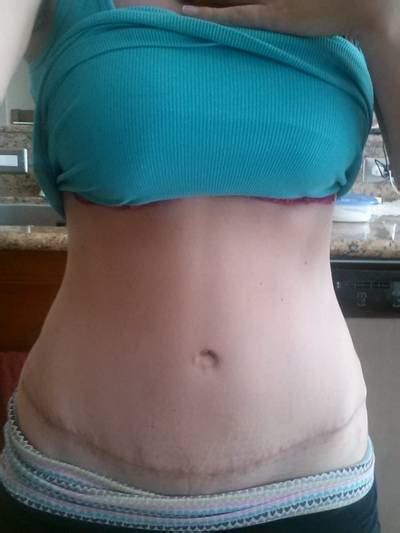 Tummy tuck before after pictures Mexico cosmetic surgeons images ...