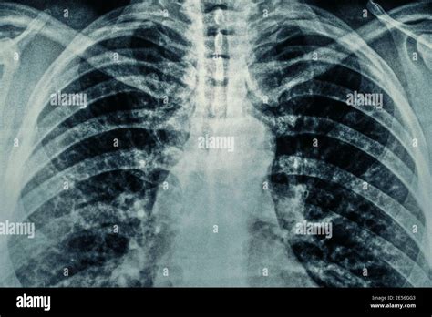 X Ray Of Lungs With Asthma