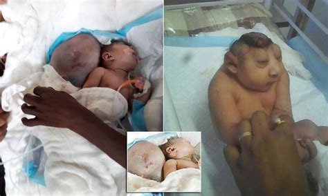 Anencephaly: the babies born without brains – Real Deal News