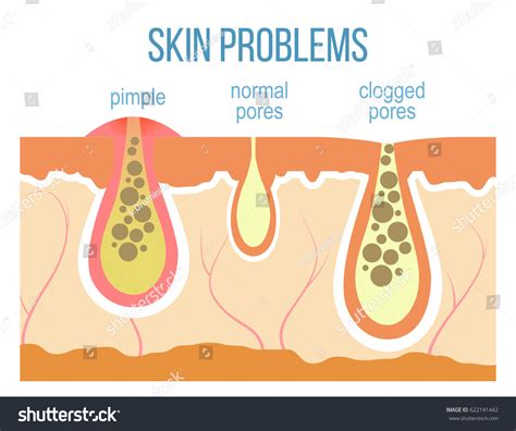 864 Pimple Diagram Images, Stock Photos & Vectors | Shutterstock