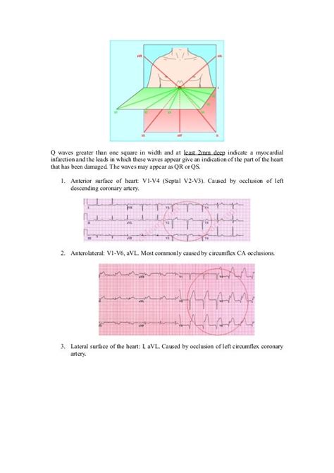 Beginners Guide for ECG Interpretation