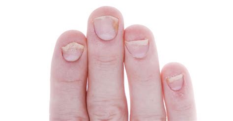 Nail Psoriasis: Telltale Signs of Nail Psoriasis and When to Seek Treatment