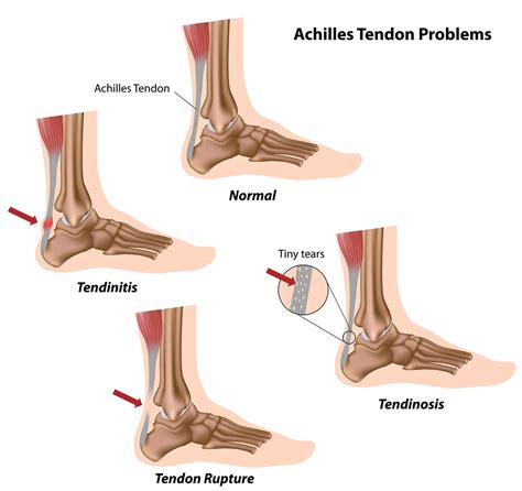 achilles tendon injuries