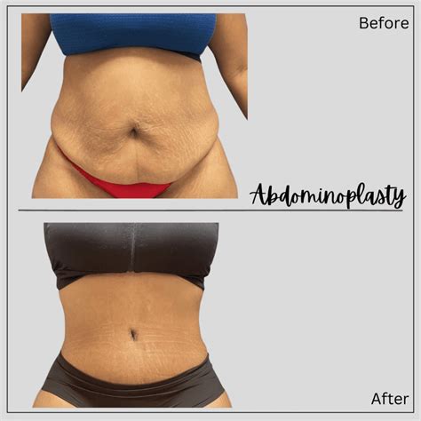 What Will Happen to My Belly Button During a Tummy Tuck | Board ...