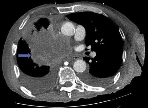 CT scan of the chest (Axial view) showing the necrotic right hilar mass... | Download Scientific ...