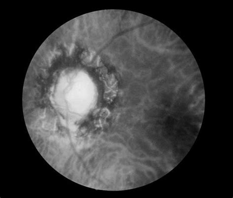 Optic atrophy | pathology | Britannica