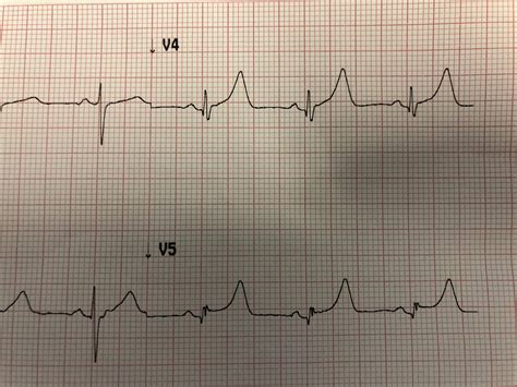 Dr. Smith's ECG Blog: Large T-waves and a Computer Interpretation of ...