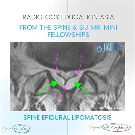 SPINE MRI EPIDURAL LIPOMATOSIS - Radedasia