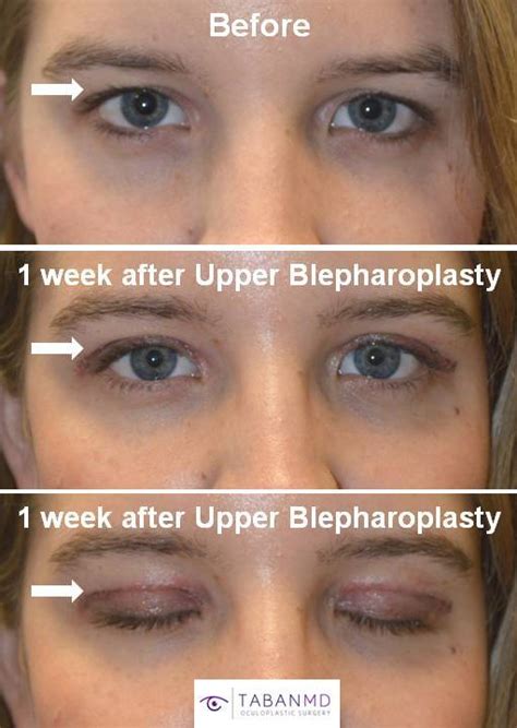 Upper Blepharoplasty Procedure by Los Angeles Eye Experts