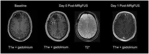 Sample T1 weighted post-gadolinium MRI from patient five obtained 30... | Download Scientific ...