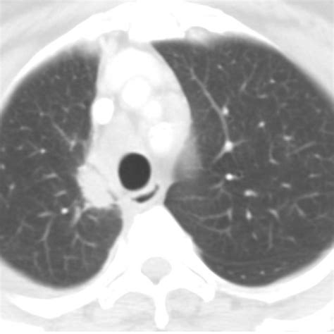 Mediastinoscopic lymph node biopsy releaving non-caseating... | Download Scientific Diagram