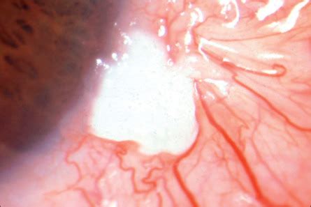 Tumors of the Conjunctiva | Ento Key