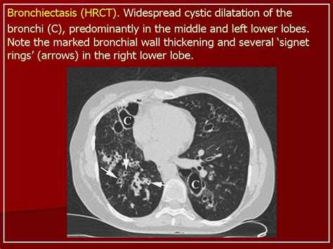 Mild Cylindrical Bronchiectasis: Comprehensive Guide to Treatment, Symptoms, and Prognosis