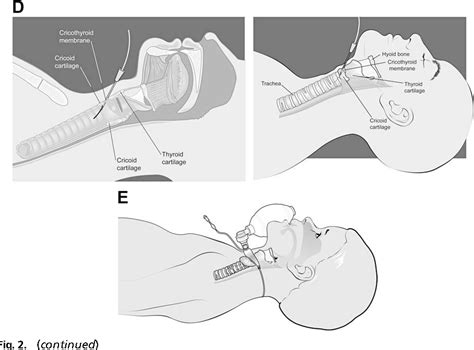 Figure 2 from Needle cricothyrotomy. | Semantic Scholar