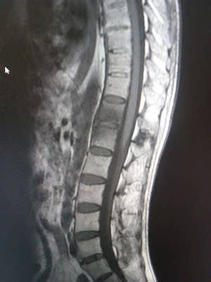 Ankylosing Spondylitis: MRI - Sumer's Radiology Blog