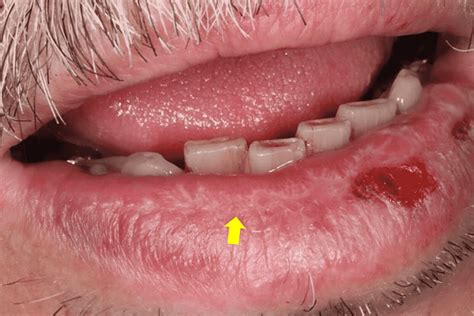 Cureus | A Retrospective Study of 23 Cases: Are Lichenoid Lesions of the Labial Mucosa Induced?