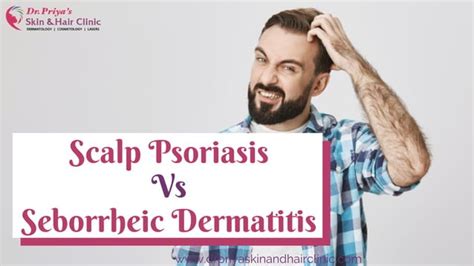 Scalp Psoriasis Vs Seborrheic Dermatitis | PPT