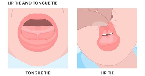 Tongue-Tie & Lip Tie Symptoms & Treatment | TherapyWorks