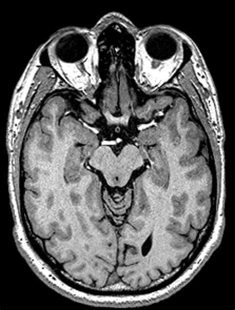 Dentate Gyrus Mri