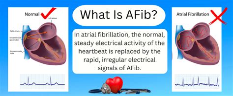 What is Atrial Fibrillation (AFib or AF)? Symptoms, Treatments ...