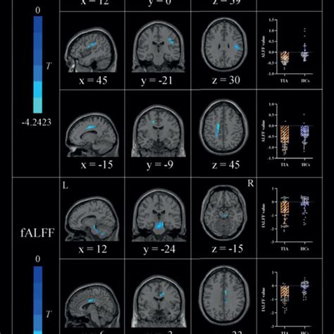 Regions of WM showing group differences in ALFF and fALFF together with ...