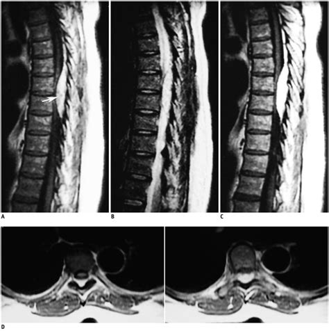 Type 1 epidural angiolipoma. 50-year-old female with bilateral lower ...