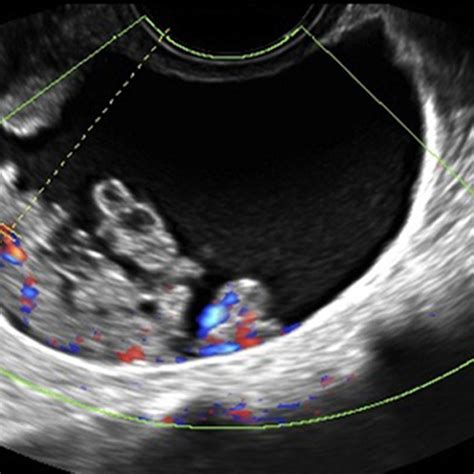 Ultrasound Training - GYN, Ovary Ultrasound