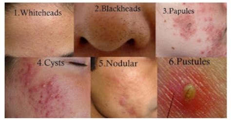 Acne | Faciem Dermatology Clinic