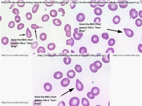 Haematology in a NutShell: Tear-Drop RBCs ( Dacrocytes)