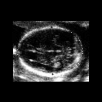 Fetal Anomaly Scans - 20 Week Fetal Scan - Baby Scans Berkshire