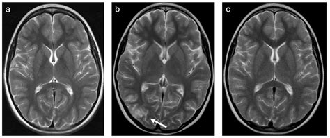 Children | Free Full-Text | Characterization of MRI White Matter Signal Abnormalities in the ...