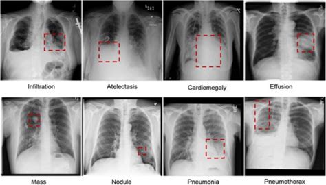 Chest X Ray Pneumonia