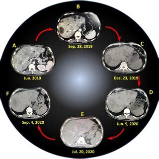 CT images of liver lesions at different time points: (A) June 2019 ...