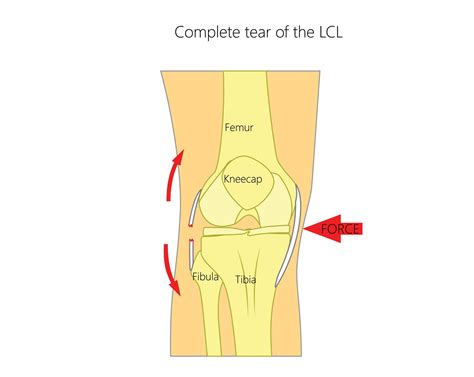 Lateral Collateral Ligament (LCL) Tears - Upswing Health | Upswing Health