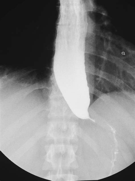 Achalasia - Gastrointestinal - Medbullets Step 2/3