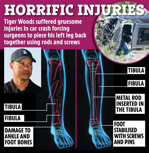 Tiger Woods ‘may never get mobility back’ and narrowly avoided his leg being AMPUTATED after ...