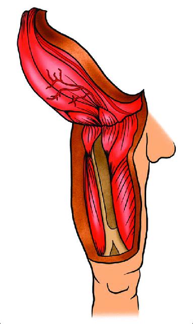 Diagram of the anterior hemipelvectomy flap. | Download Scientific Diagram