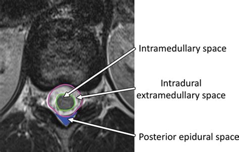 Nontraumatic Spinal Cord Compression: MRI Primer for Emergency ...