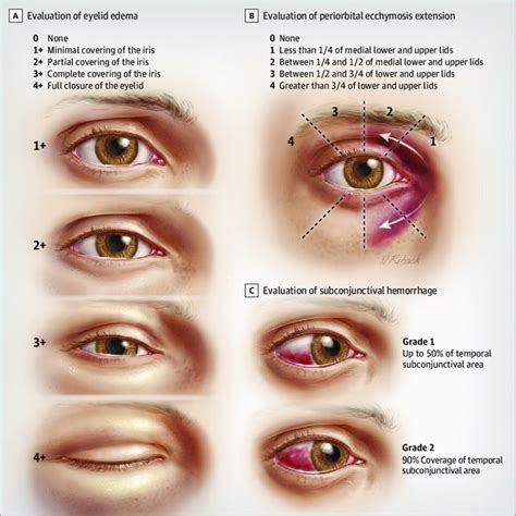 Differences in Postoperative Eyelid Edema, Periorbital Ecchymosis, and... | Download Scientific ...