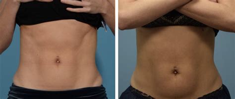 BODY SCULPTING : WHAT IS IT AND HOW IS IT DONE? | by ALLURE LASER STUDIO | Medium